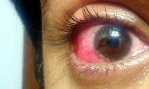 Image of human eye infected with Conjunctivitis