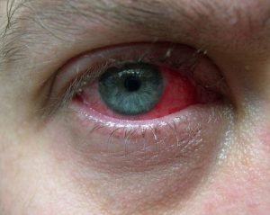 Picture of human infected with Conjunctivitis